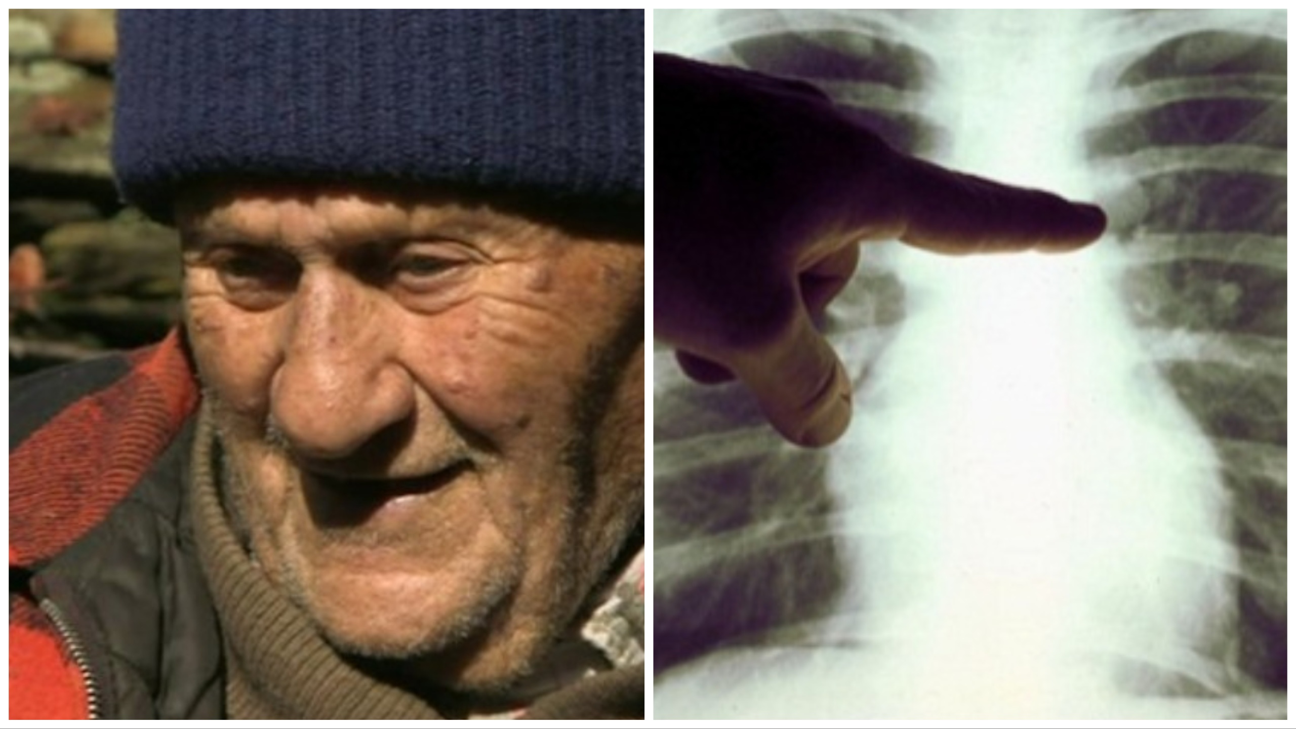 Il aurait dû mourir au bout de 9 mois, il survit 45 ans : l'histoire de l'île qui "trompe" le cancer