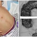 stitichezza medici le estraggono un pitone di feci di 20 kg