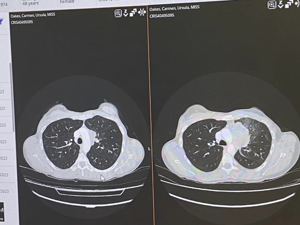 Se salva del cáncer de piel y se broncea: el cáncer vuelve