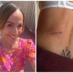 Si salva da tumore alla pelle e va ad abbronzarsi: il cancro torna