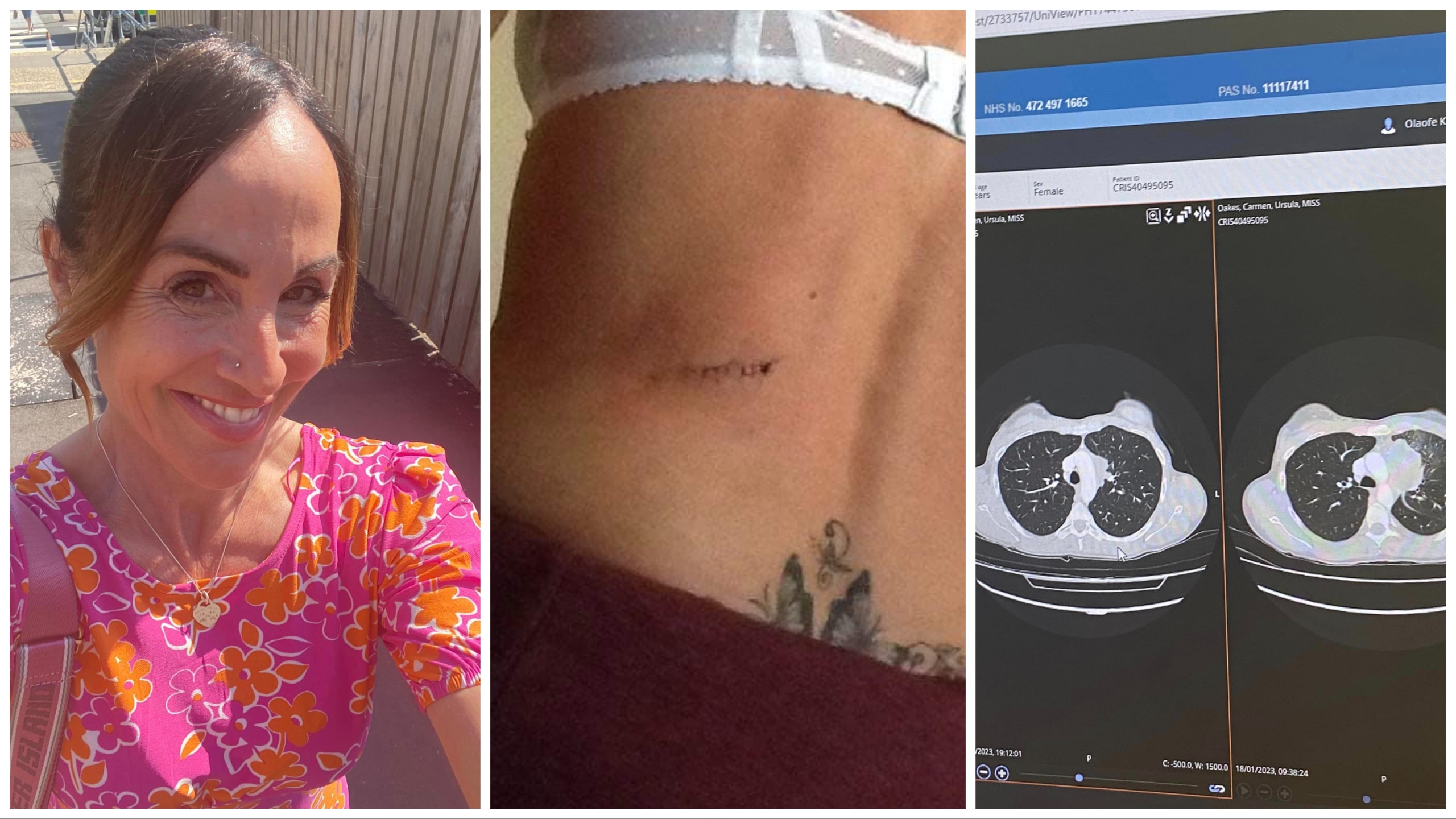 Se salva del cáncer de piel y se broncea: el cáncer vuelve