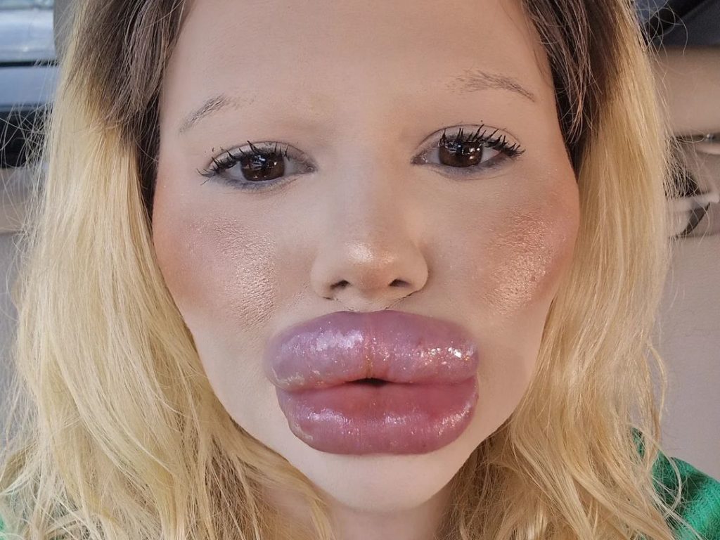 Labios récord con relleno, ahora se juega la vida para agrandar sus pómulos