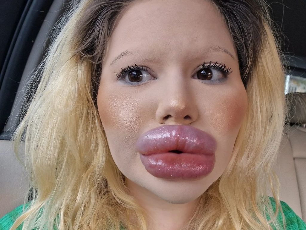 Labios récord con relleno, ahora se juega la vida para agrandar sus pómulos