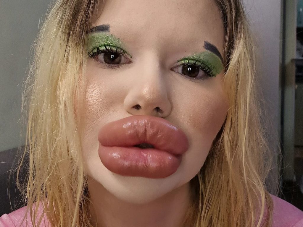 Rekordverdächtige Lippen mit Filler, jetzt riskiert sie ihr Leben, um ihre Wangenknochen zu vergrößern