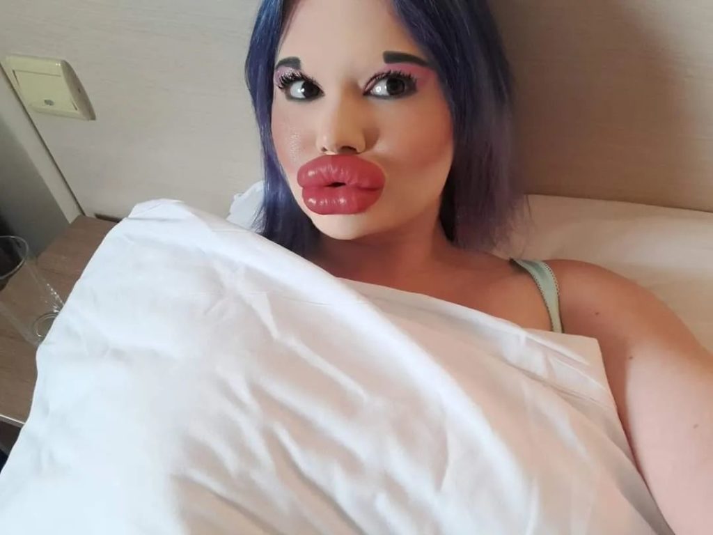 Labios récord con relleno, ahora se juega la vida para agrandar sus pómulos