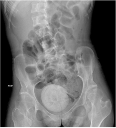 Calcolo vaginale grosso come un'arancia: medici sotto shock