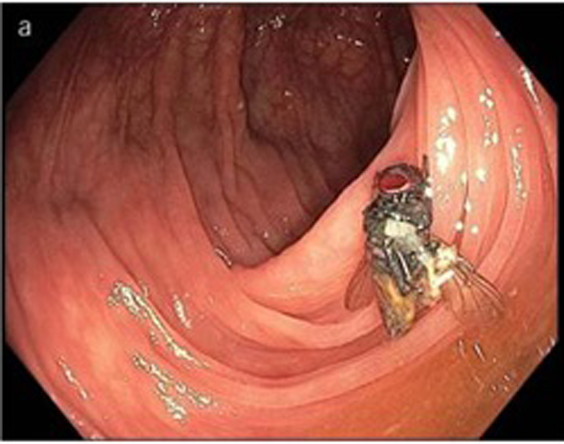 Mosca viva encontrada durante colonoscopia: misterio de cómo llegó allí