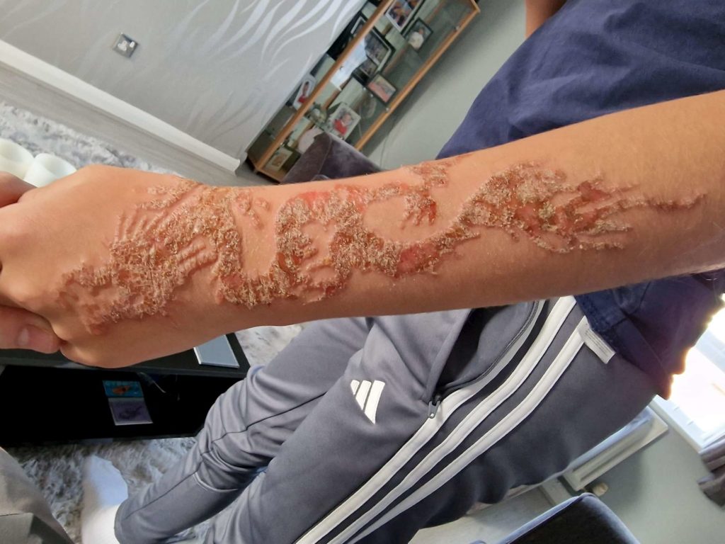 Niño se tatúa henna durante vacaciones: se quema el brazo