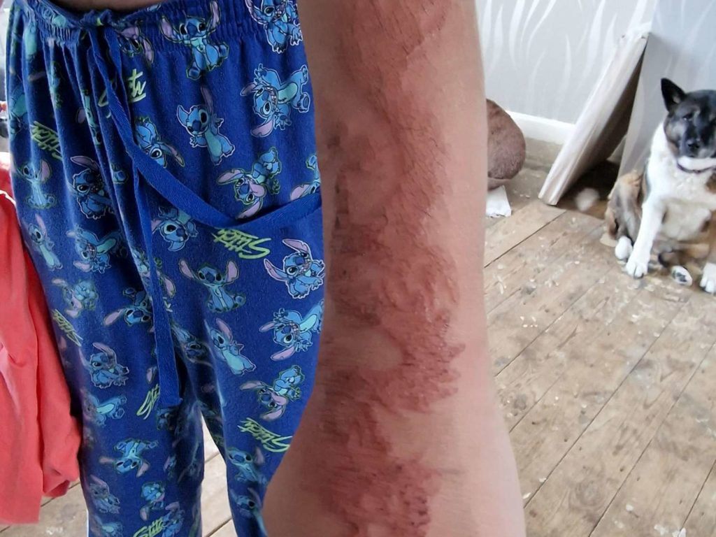 Niño se tatúa henna durante vacaciones: se quema el brazo