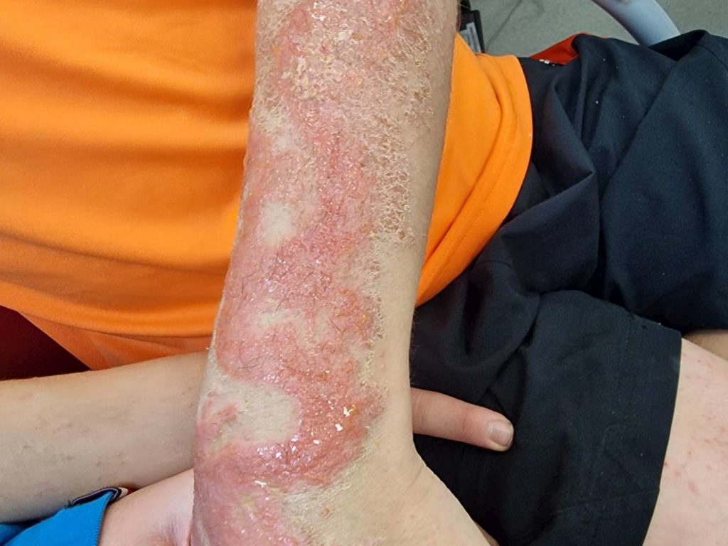 Niño se tatúa henna durante vacaciones: se quema el brazo