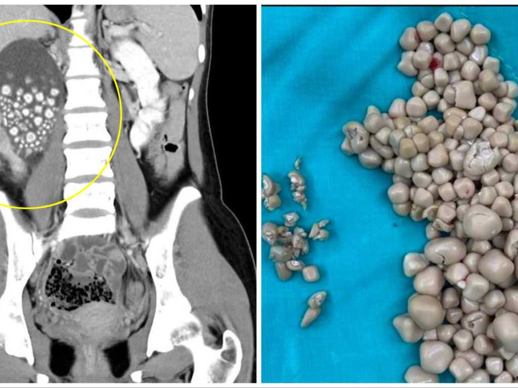 Beveva solo "bubble tea" anziché acqua: le trovano 300 calcoli renali