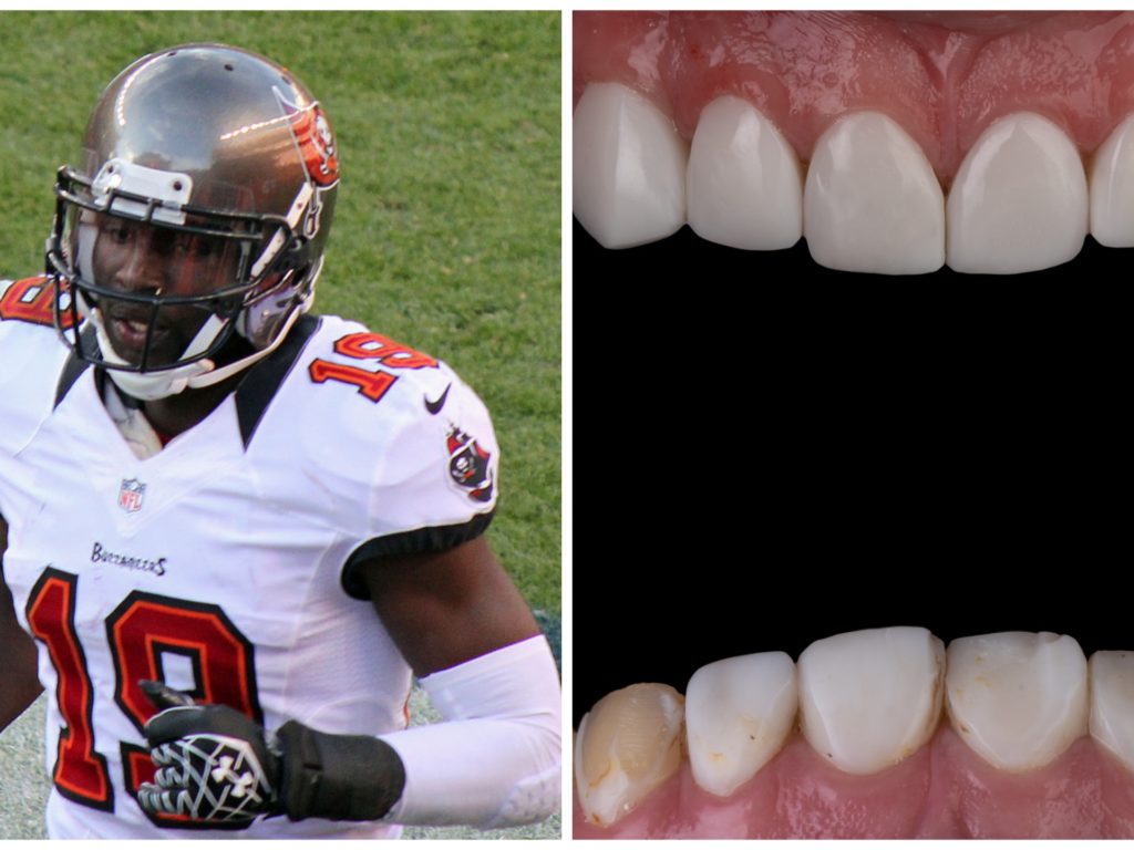 Ex giocatore di football Nfl muore per una carie ai denti