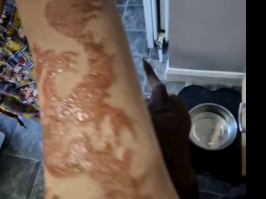 Niño se tatúa henna durante vacaciones: se quema el brazo