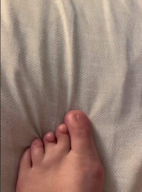 Nacida sin uñas de los pies, descubre en las redes sociales que no está sola: "He renacido"