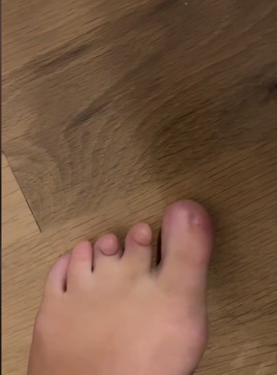 Nacida sin uñas de los pies, descubre en las redes sociales que no está sola: "He renacido"