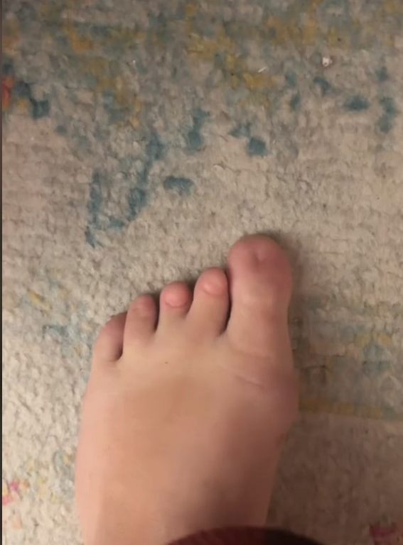 Nacida sin uñas de los pies, descubre en las redes sociales que no está sola: "He renacido"