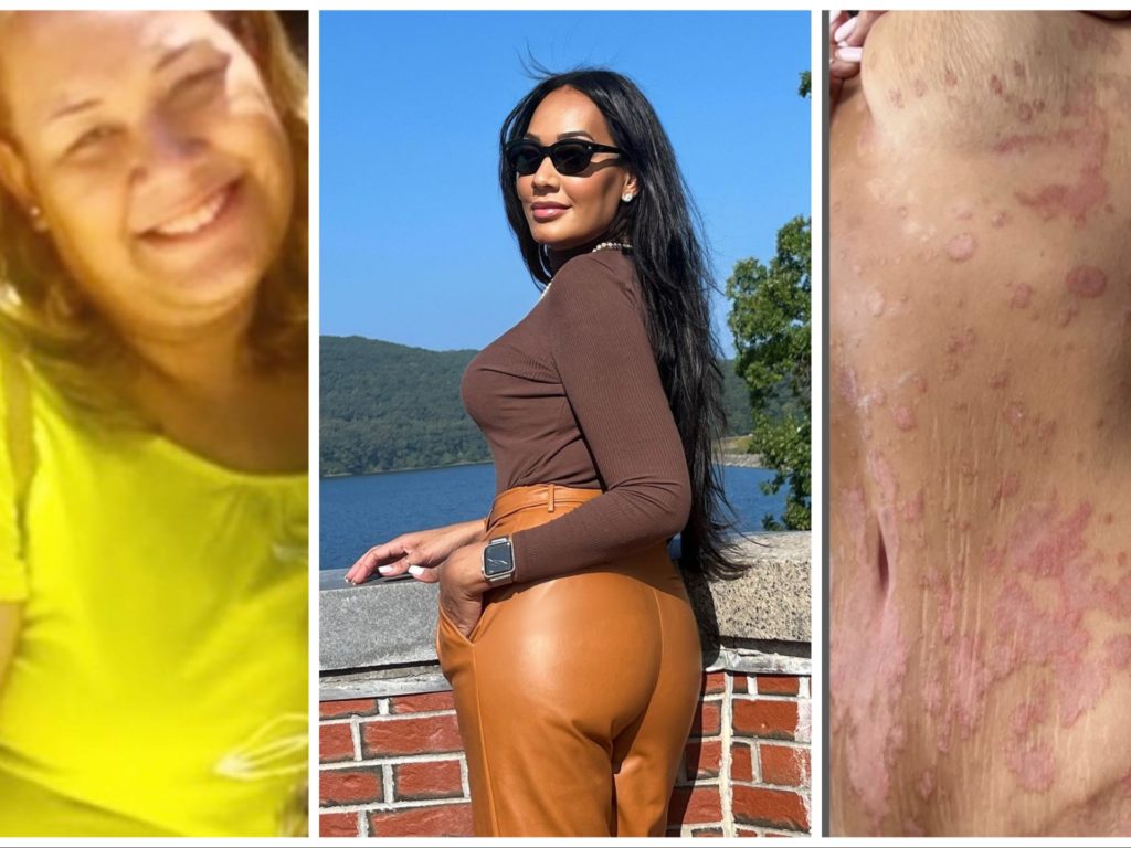 Influencer fit de 35 años que murió de un infarto: tenía una misteriosa psoriasis