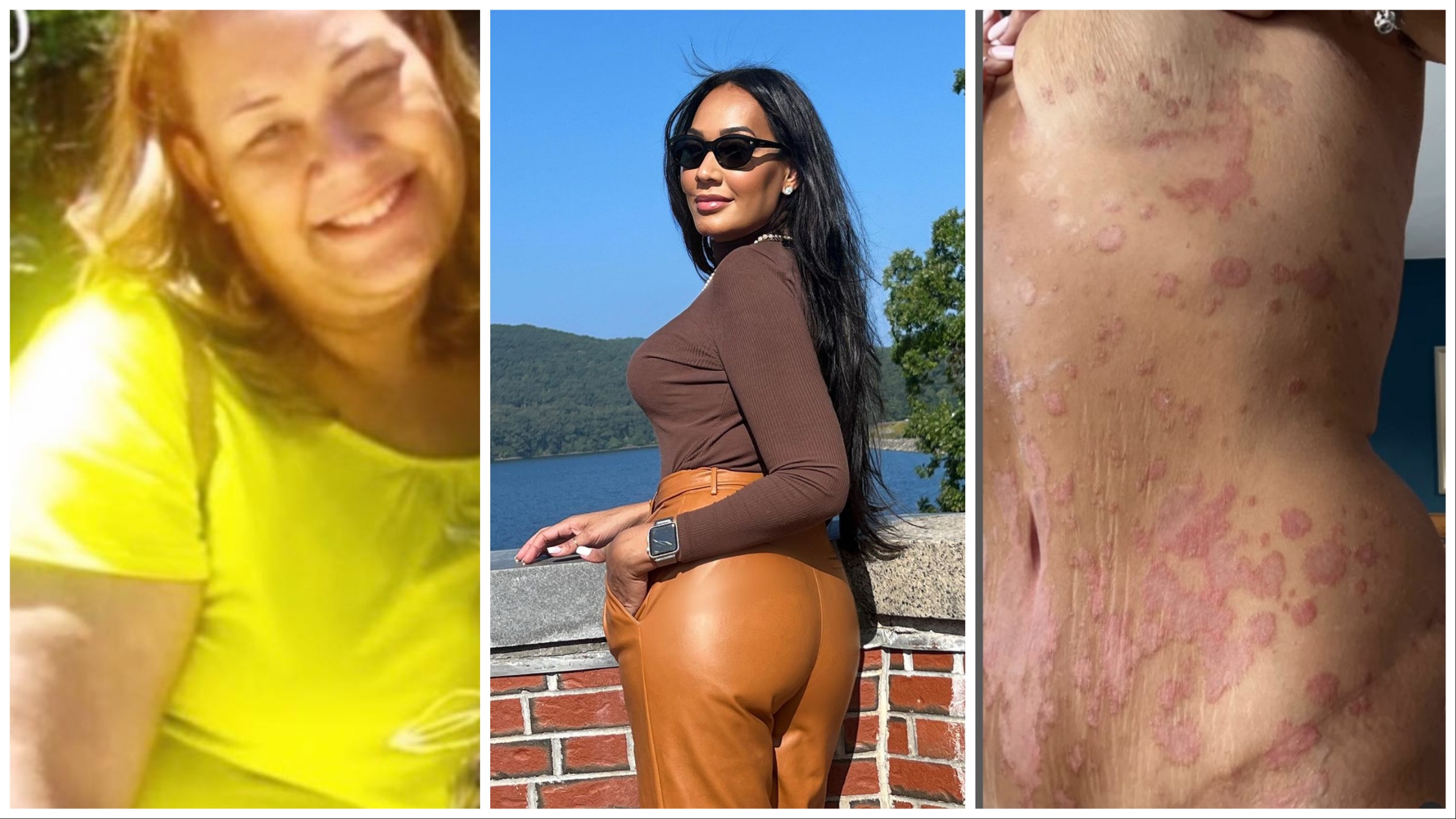 Influencer fit de 35 años que murió de un infarto: tenía una misteriosa psoriasis