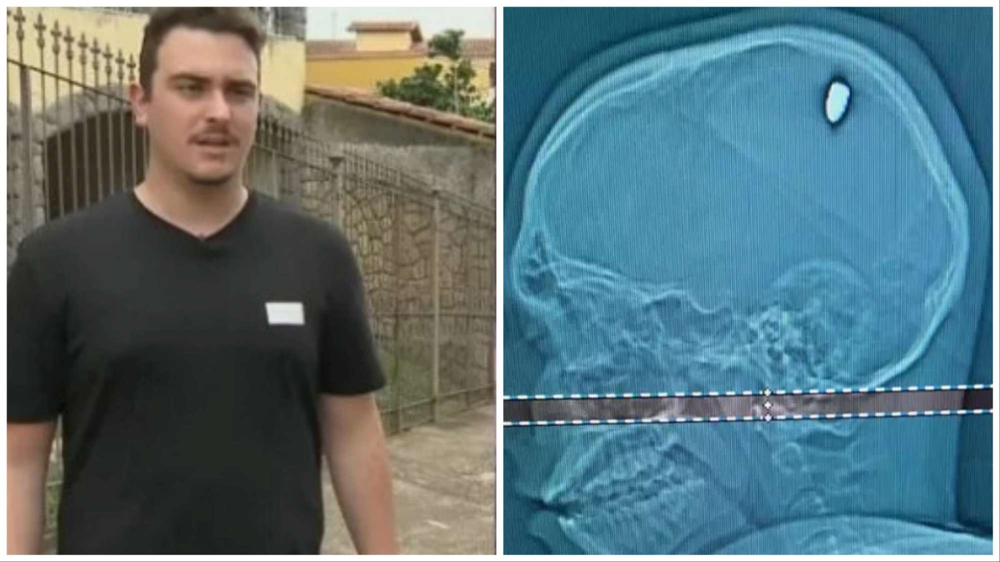 Baleado en Nochevieja, 4 días después descubrió una bala en el cráneo