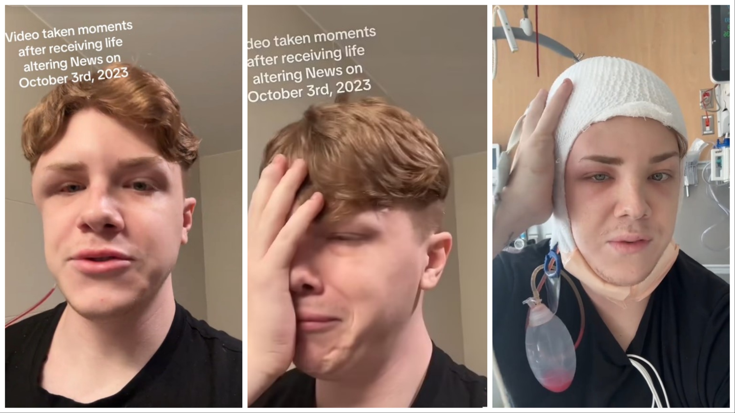 Le quitan el cráneo para lavarle el cerebro: infección por drenaje olvidado