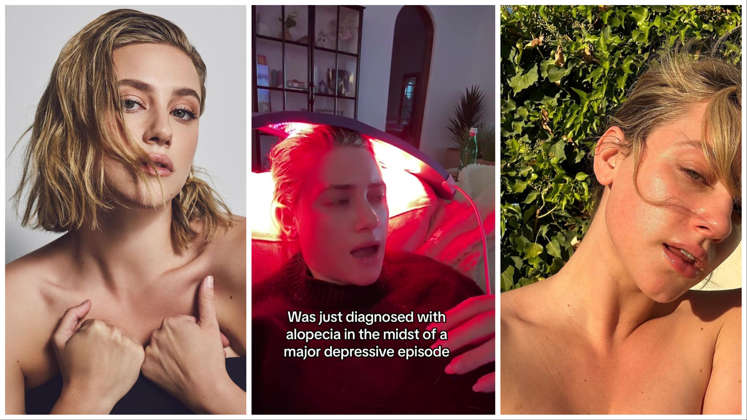 Lili Reinhart: sta diventando calva per la depressione