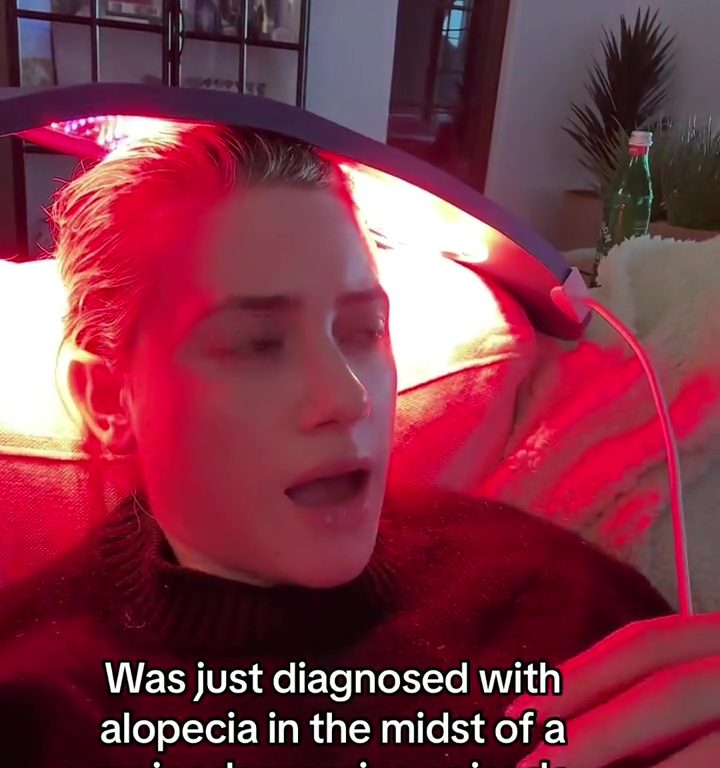 Lili Reinhart: sta diventando calva per la depressione