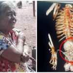 Donna con feto morto nell'utero per 56 anni: la operano e muore