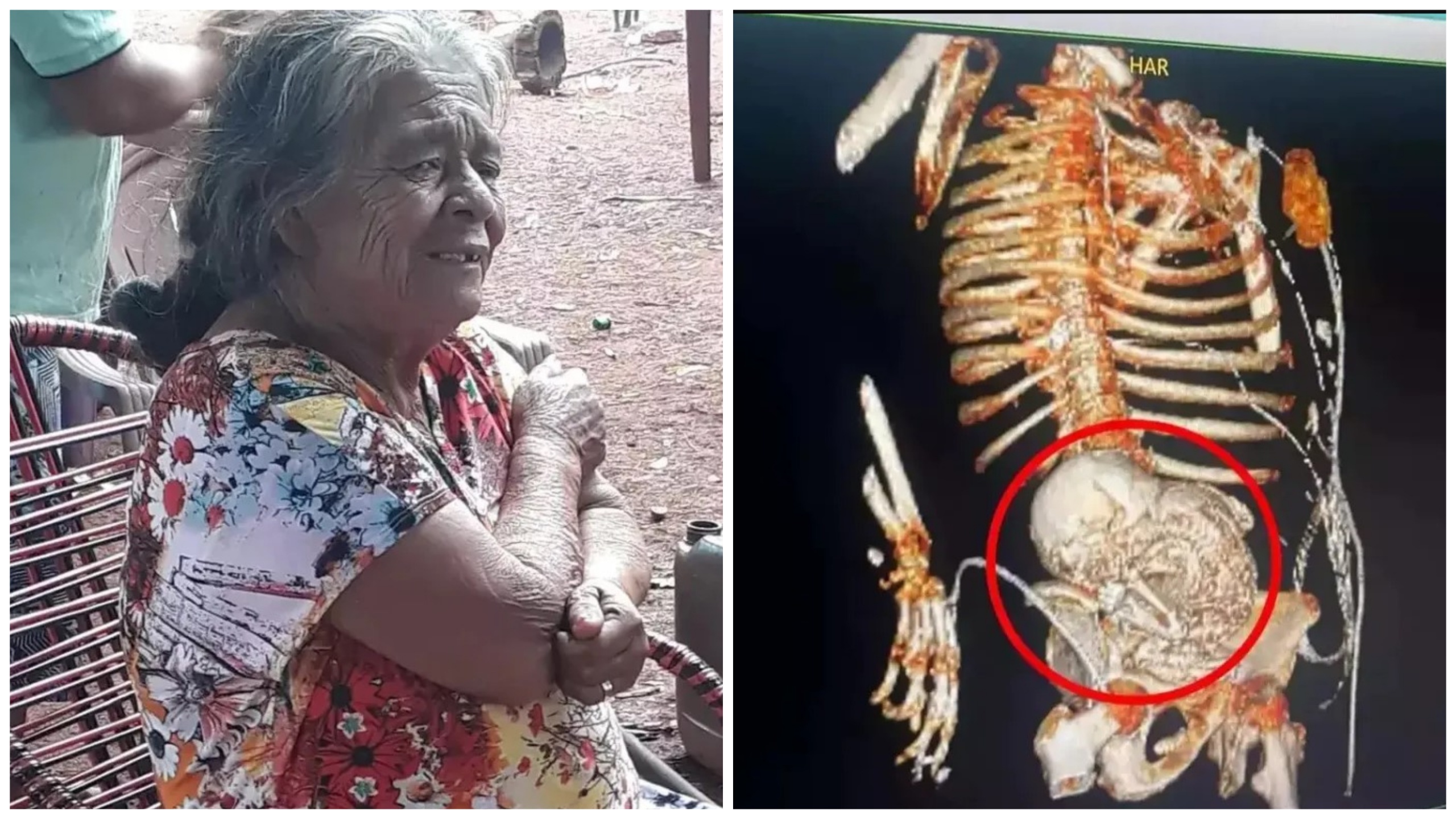 Donna con feto morto nell'utero per 56 anni: la operano e muore