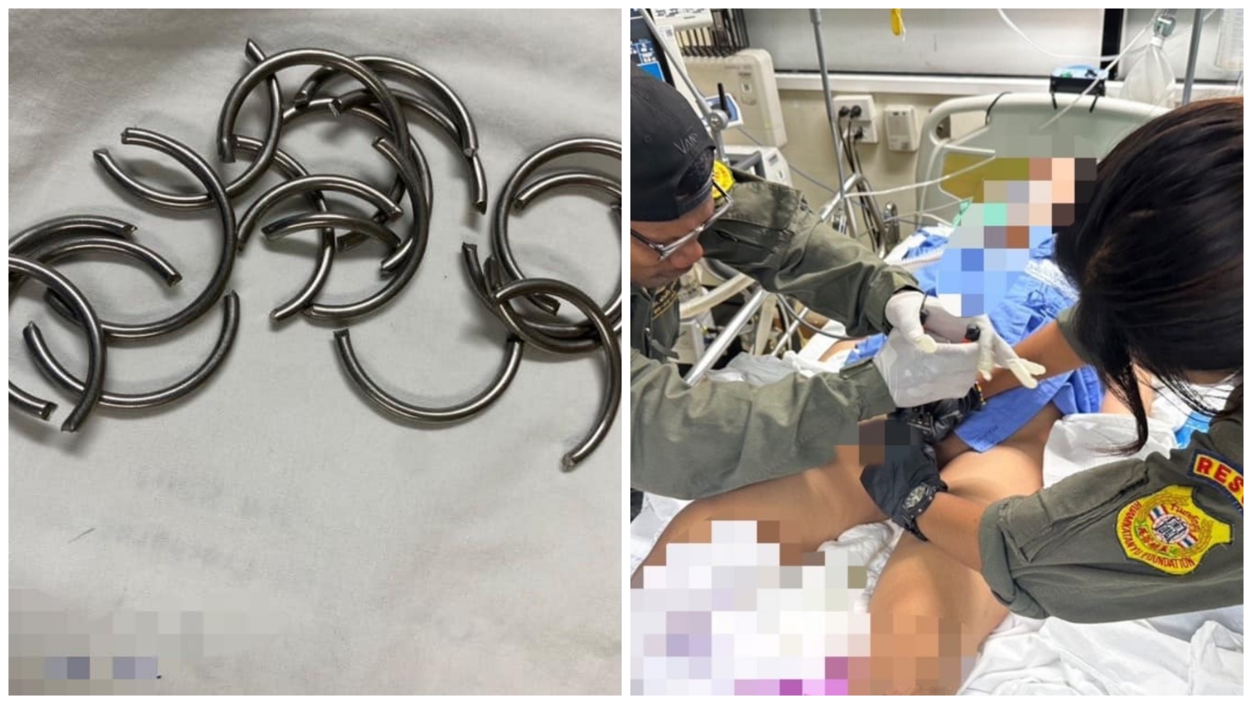 Si incastra 11 anelli penici e va in ospedale: medico lo salva col tronchese