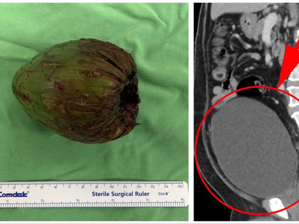 Uomo con una noce di cocco nel sedere: un caso che fa riflettere