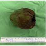 Uomo con una noce di cocco nel sedere: un caso che fa riflettere