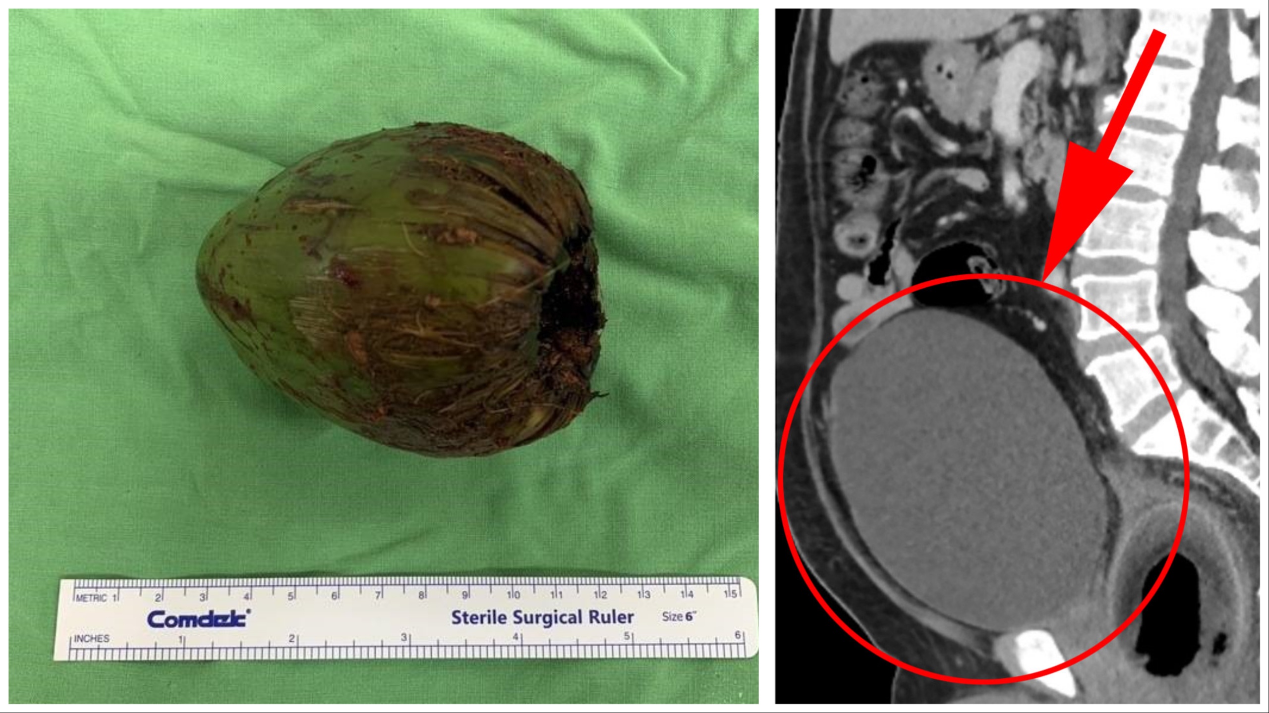 Uomo con una noce di cocco nel sedere: un caso che fa riflettere