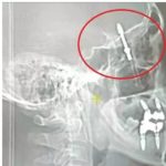 El dentista se equivoca y aprieta demasiado el implante: el tornillo entra en el cráneo
