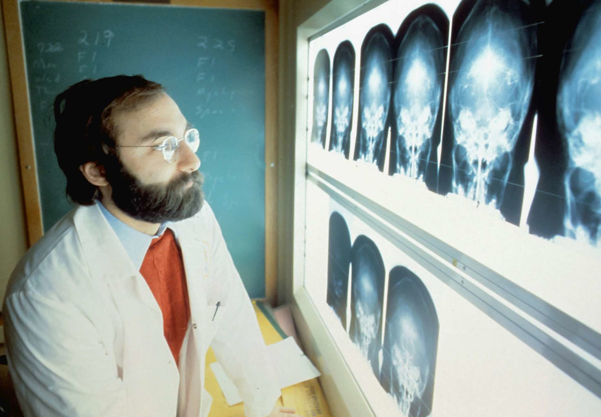 La vacuna contra el cáncer de cerebro mediante la técnica de ARNm de Covid funciona por ahora