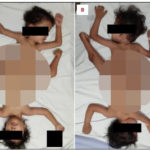 Descubierto el caso de las gemelas siamesas "araña": les amputaron una pierna para poder sentarse