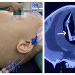 Una niña nace con el feto de las gemelas creciendo en su cráneo y sobrevive un año