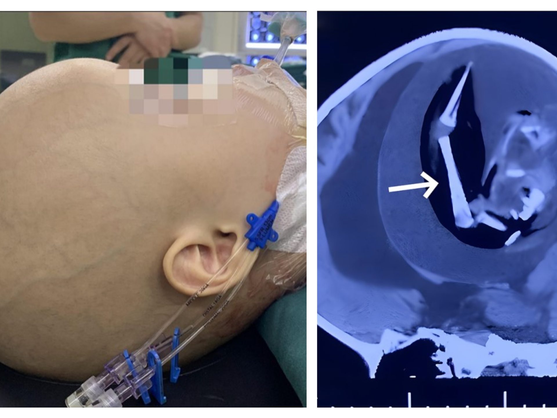 Bimba nasce col feto della gemella che cresceva nel cranio sopravvive un anno