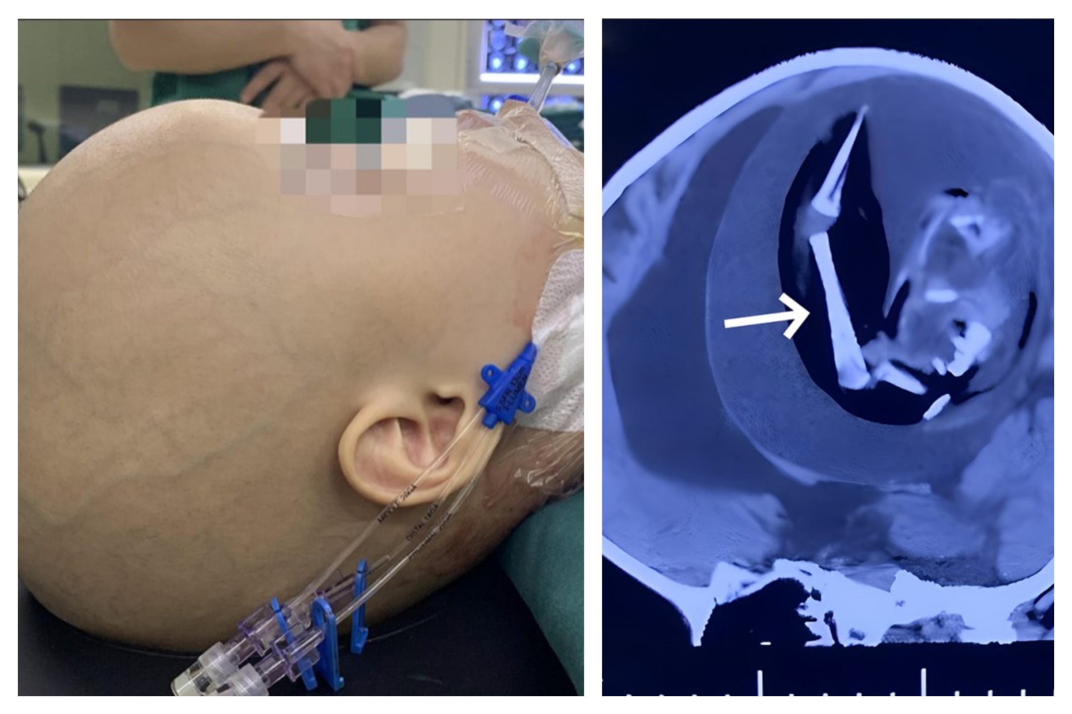 Bimba nasce col feto della gemella che cresceva nel cranio sopravvive un anno