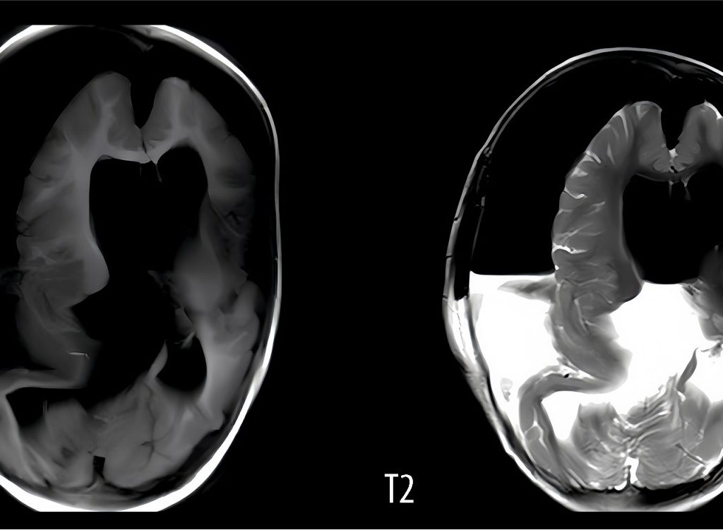 Bimba nasce col feto della gemella che cresceva nel cranio sopravvive un anno