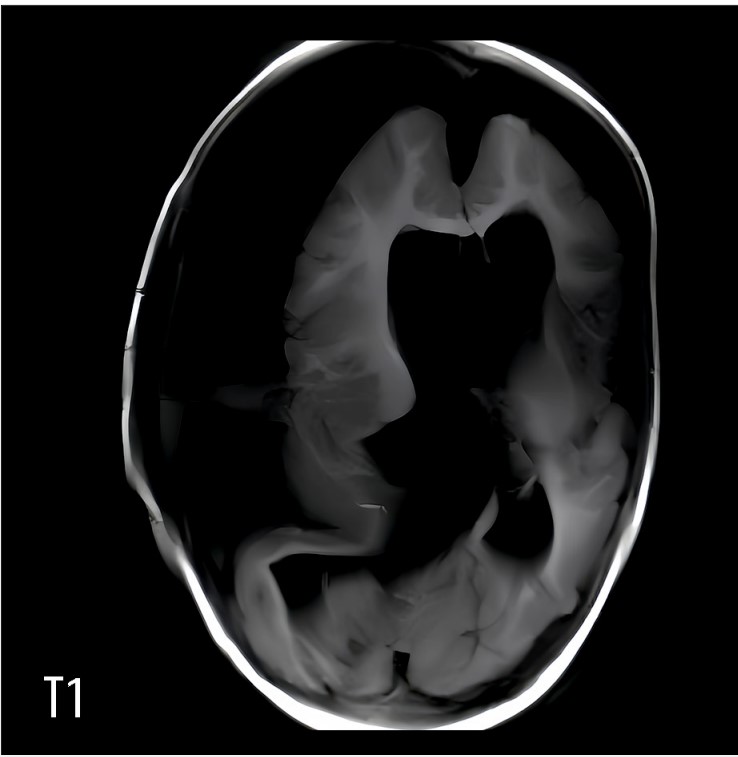 Bimba nasce col feto della gemella che cresceva nel cranio sopravvive un anno