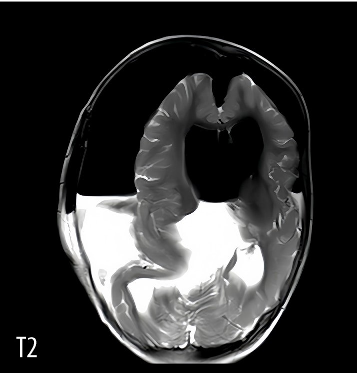 Bimba nasce col feto della gemella che cresceva nel cranio sopravvive un anno