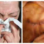 Enfermo de Covid la tos expulsa los intestinos y salva el vientre