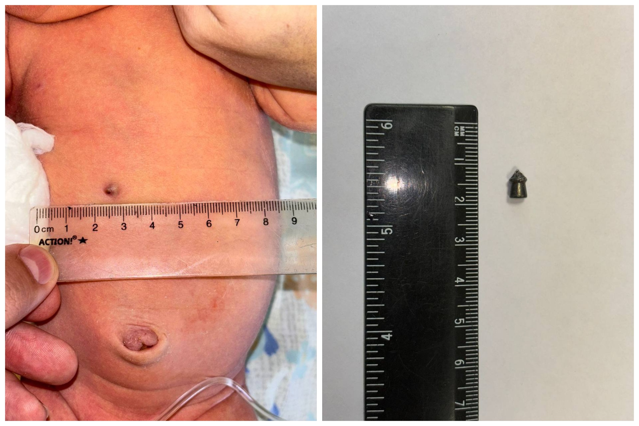 Accidentalmente dispara en el vientre a su esposa embarazada, bebé recién nacido nace con bala en el cuerpo