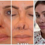 L'ex-femme du footballeur Arshavin perd son nez à cause d'une nécrose : reconstruit par des chirurgiens