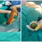 Le meten una anguila viva en el ano y el animal le come los intestinos: lo operaron