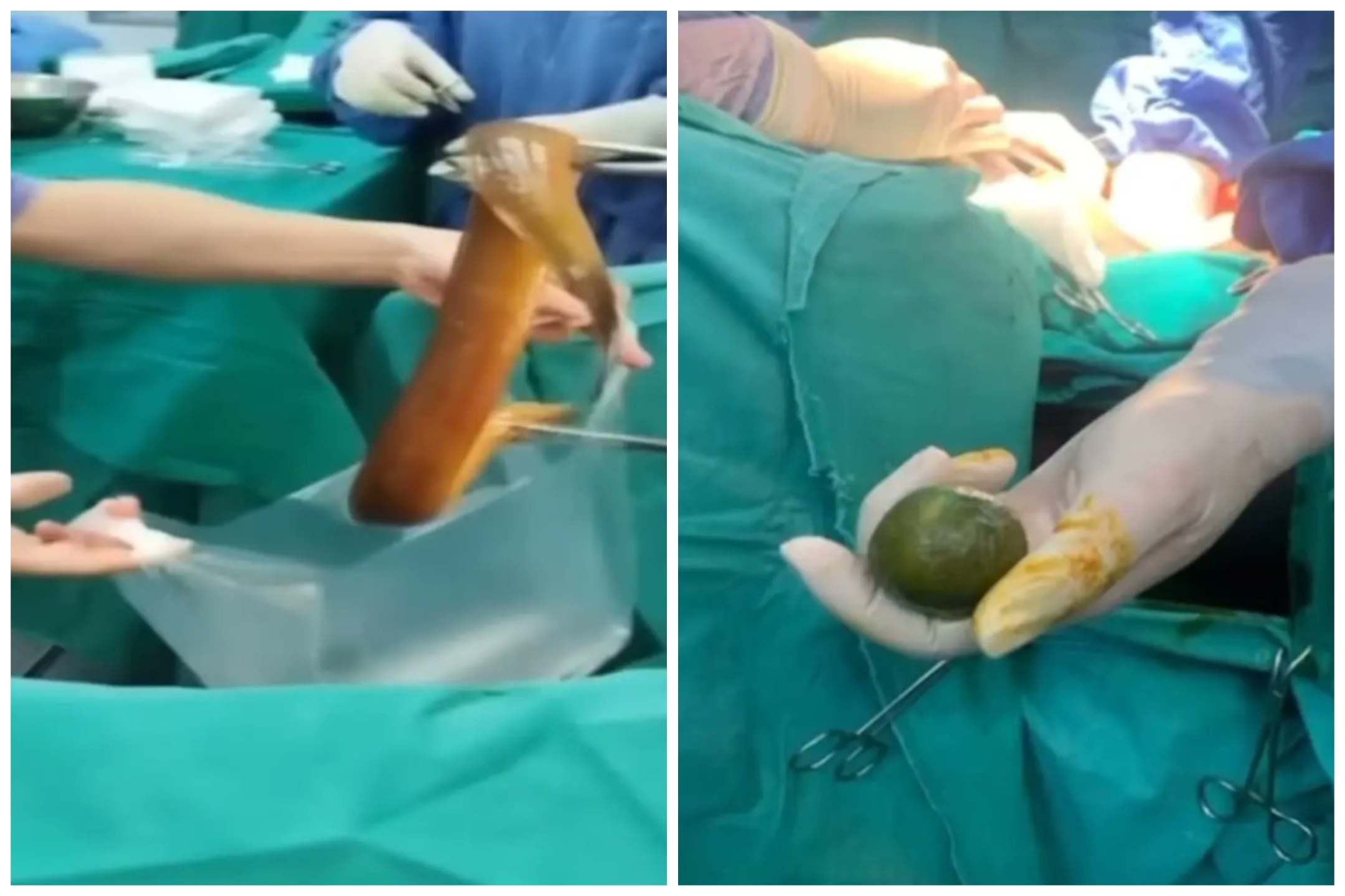 Si infila anguilla viva nell'ano e l'animale gli mangia l'intestino: operato