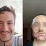 Joven va a Türkiye para una cirugía estética de barba a bajo coste y regresa desfigurado y se suicida