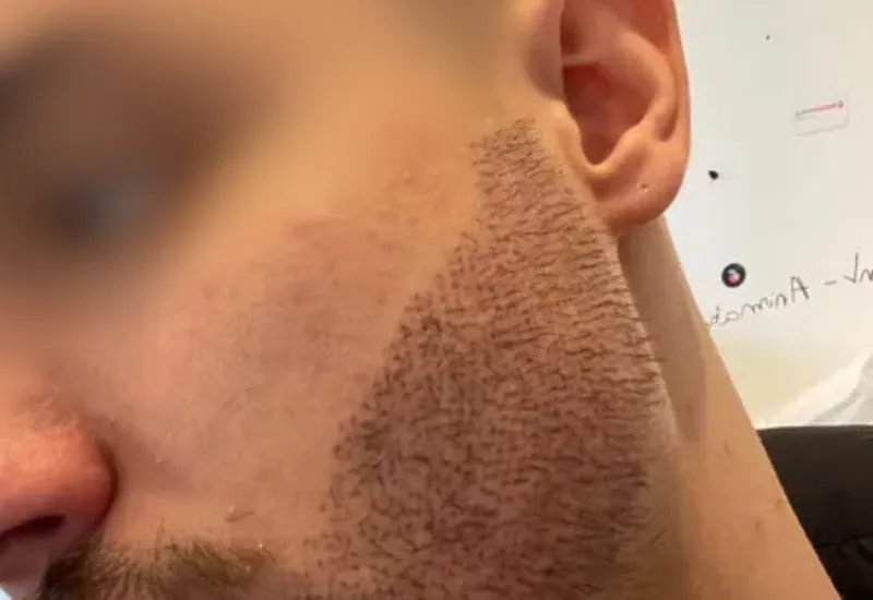 Joven va a Türkiye para una cirugía estética de barba a bajo coste y regresa desfigurado y se suicida