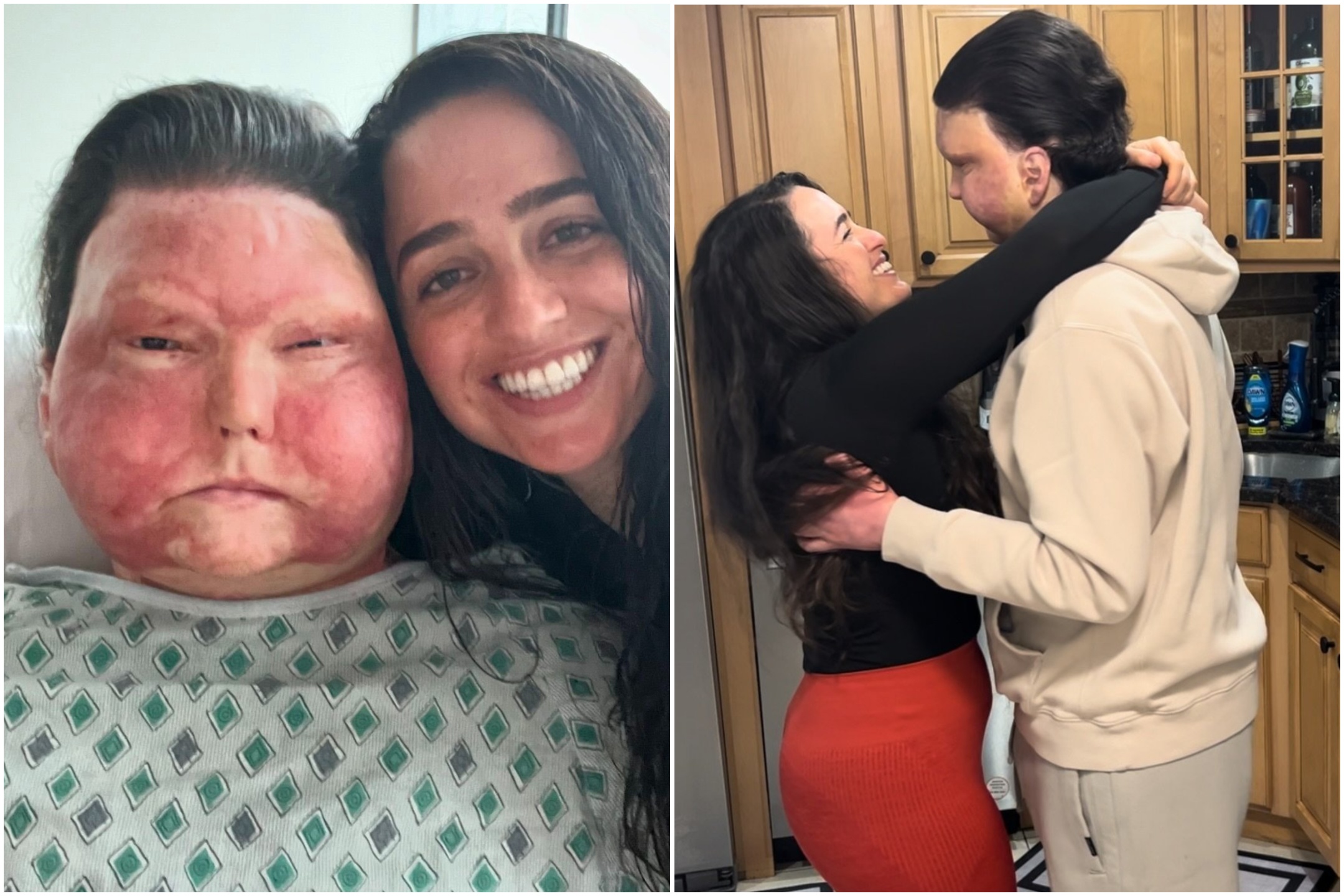 Der erste Mann mit einer Gesichts- und Handtransplantation hat die Liebe gefunden: Er heiratet jetzt