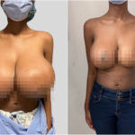 Die Covid-Impfung lässt die Brüste einer 19-Jährigen explodieren: In sechs Monaten geht sie von der dritten in die elfte Klasse